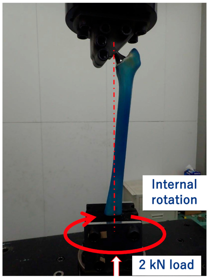 Comparison of Fracture Resistance Using Two Different Major Cemented Stems in Osteoporotic Bone Models.