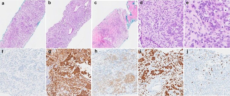 A case of GLI1-altered mesenchymal pleural tumour with novel gene fusion: a clinical perspective.