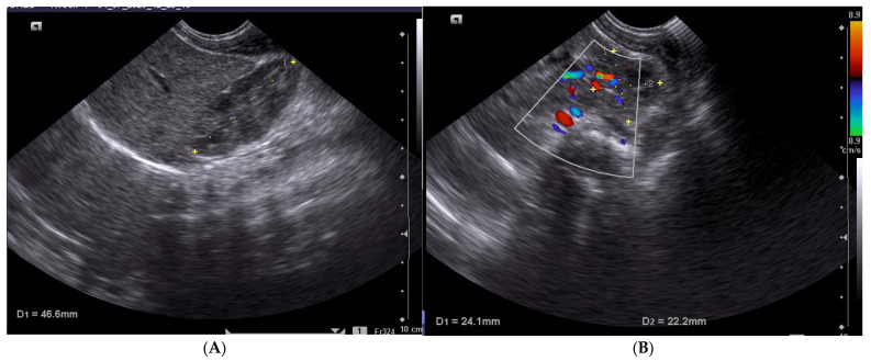 Neonatal Renal Ultrasound Reference Values in Romanian Term Newborns: Correlations with Anthropometric Characteristics.