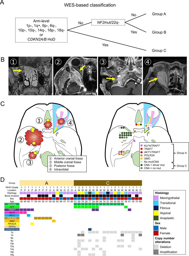 Two molecular subtypes of skull base meningiomas with extracranial extension.