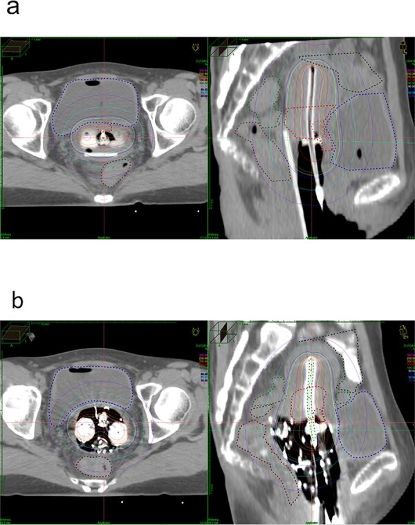 Comparison of rectal and bladder dose between retractor insertion and gauze packing in intracavitary brachytherapy for cervical cancer.