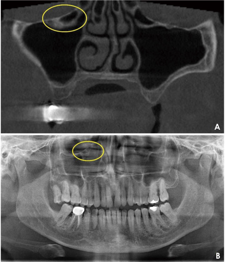 Prevalence and radiographic features of Haller cells: A systematic review.