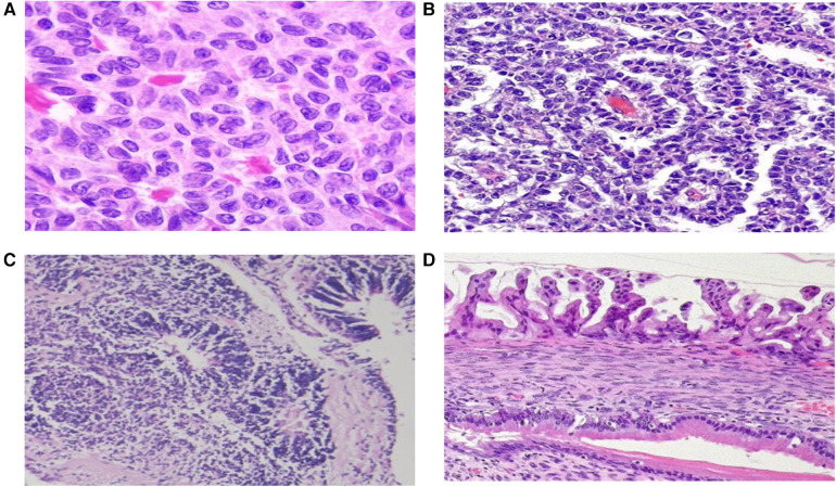 Pediatric and young adult ovarian masses: clinical approach, diagnostic evaluation, and management.