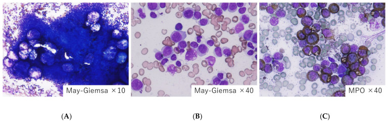 Characteristics of Myelodysplastic Syndrome with Coagulation Abnormalities and Tailored Diagnosis and Treatment.