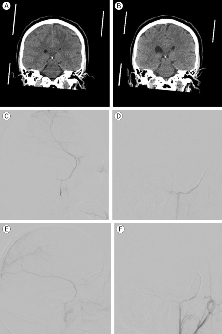 Noninferiority of coiling versus coiling with particles in middle meningeal artery embolization: A technical note and case series.