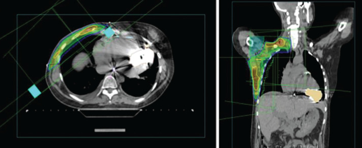 Safe Delivery of Radiotherapy for Breast Cancer Patient With Left Ventricular Assist Device: Case Report and Review of the Literature.