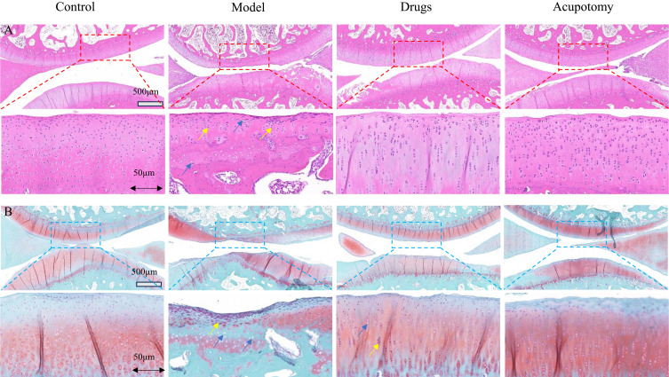 Effect of Acupotomy Modulation of NLRP3/Caspase-1/GSDMD Pathway on Chondrocyte Pyroptosis in Knee Osteoarthritis.