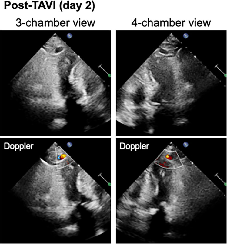 Assessment and treatment of left ventricular pseudoaneurysm due to wire injury in transcatheter aortic valve implantation: a case report.