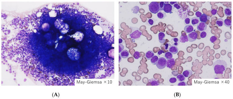 Characteristics of Myelodysplastic Syndrome with Coagulation Abnormalities and Tailored Diagnosis and Treatment.