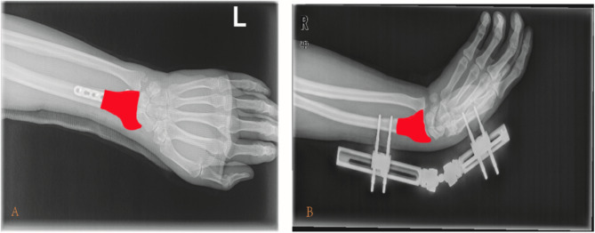 Combining radiomics of X-rays with patient functional rating scales for predicting satisfaction after radial fracture fixation: a multimodal machine learning predictive model.