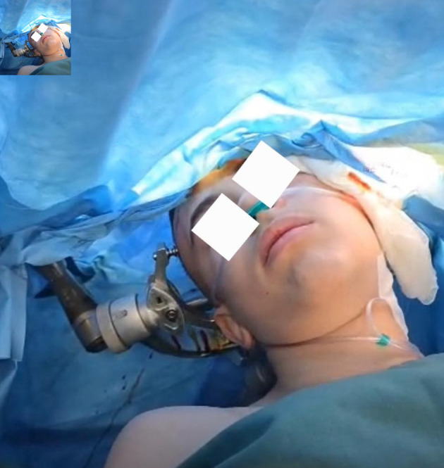 Ketofol (Ketamine-Propofol) in Pediatric Awake Neurosurgery: An Anesthetic Perspective.