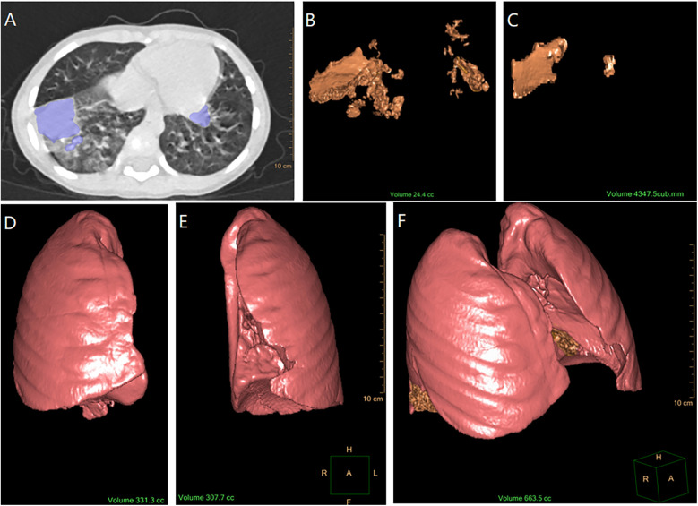 Lung consolidation absorption time in 238 pediatric cases of mycoplasma pneumoniae pneumonia.