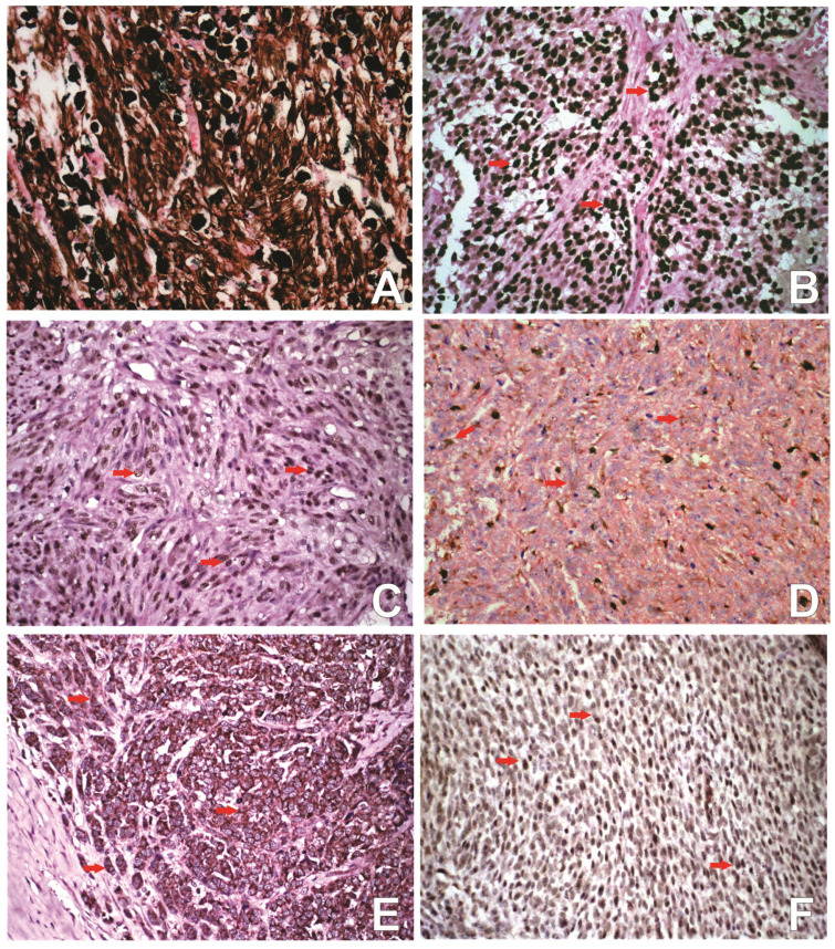 SOX Family Members Expression in Canine Oral Melanoma: Role of the SOX3 in Tumor Aggressiveness.