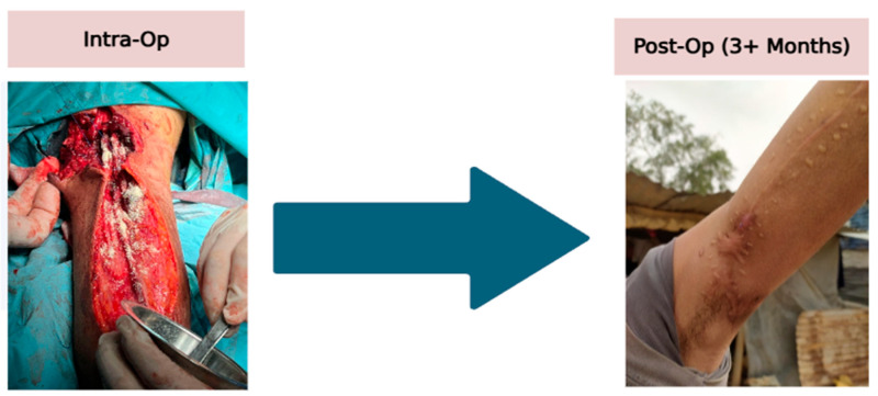 Utilization of a Multi-Tissue Extracellular Matrix in Complex Wound Care in Gaza: A Case Series.