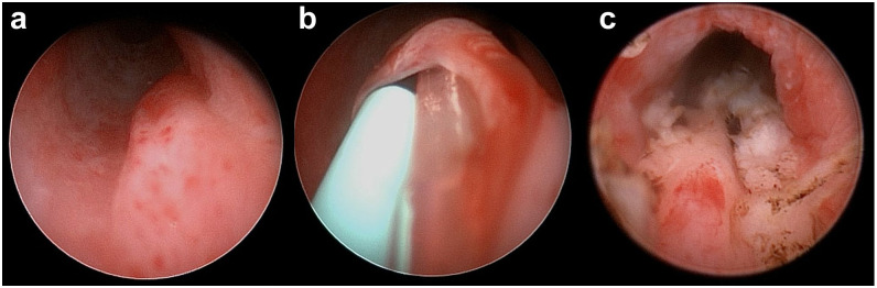 Long-term outcome of ectopic ureter treatment in four female cats.