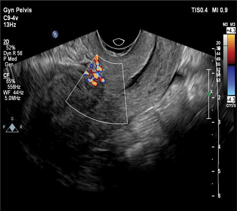 Could Hypogastric Artery Ligation Be An Alternative To Artery Embolization For Managing Vaginal Bleeding? A Case Report.