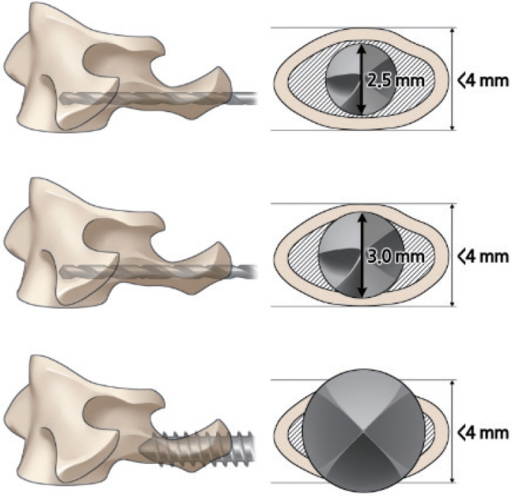 Atlantoaxial Reconstruction: The Artful Evolution of Craniovertebral Junctional Spine Surgery.