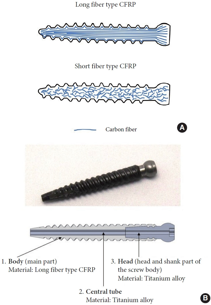 Long Fiber Type Carbon Fiber Reinforced Plastic Pedicle Screws Exhibit High Strength, Comparable to Titanium-Alloy Screws, and Are Resistant to Loosening.