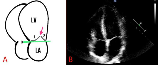 Management of Arrhythmic Mitral Valve Prolapse: Potential Impact and Current Evidence.