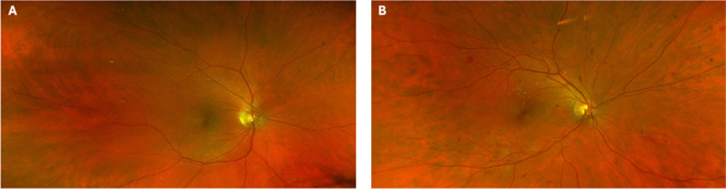 How early can we detect diabetic retinopathy? A narrative review of imaging tools for structural assessment of the retina.
