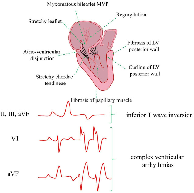 Management of Arrhythmic Mitral Valve Prolapse: Potential Impact and Current Evidence.