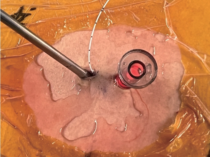 Real-Time Water Pressure Monitoring in Unilateral Biportal Endoscopic Spine Surgery.