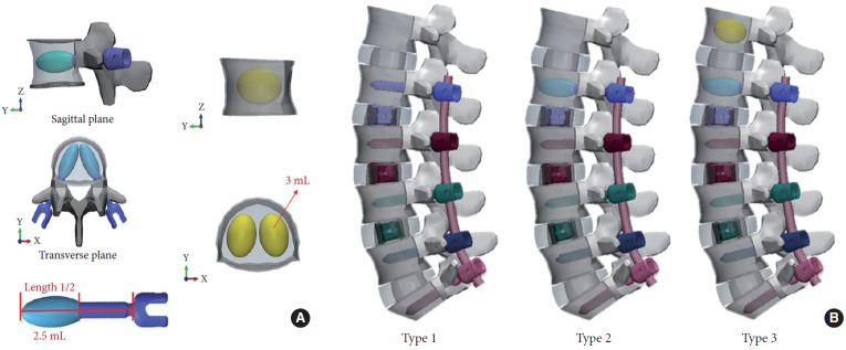 Biomechanical Impact of Cement Augmentation on Pedicle Screw Fixation and Adjacent Segment Disease in Multilevel Lumbar Fusion: A Finite Element Analysis.