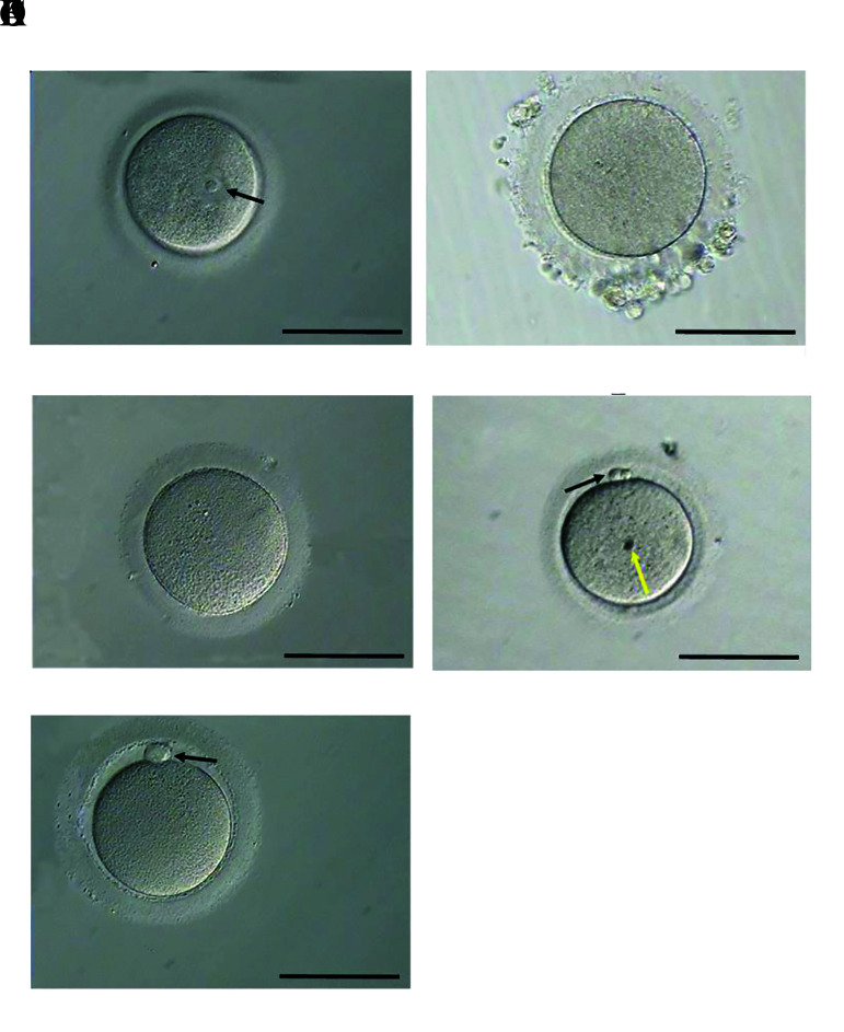 Application of Autologous Platelet-Rich Plasma-Supplemented Medium Promotes <i>In Vitro</i> Maturation of Human Germinal Vesicle Oocytes.