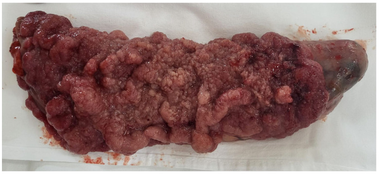 McKittrick-Wheelock Syndrome, a Rare Cause of Nonresponsive Persistent Dyselectrolytemia.
