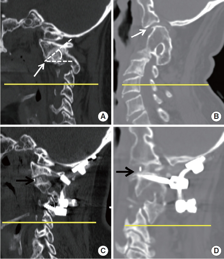Prognostic Factors in Craniocervical Realignment for Crainovertebral Junction Kyphosis With Negative Cervical Imbalance: A Comprehensive Study.