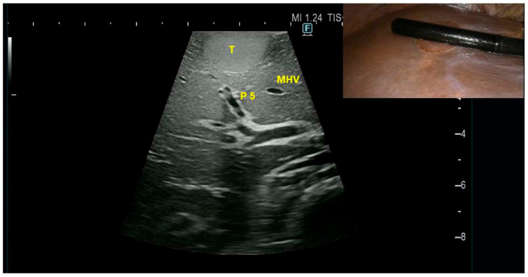 Hepatic Focal Lesion Suspicious for Hepatocellular Carcinoma in a Patient with a History of Post-Traumatic Splenectomy: The Challenge of Differential Diagnosis with Intrahepatic Splenosis-Literature Review and Case Report.