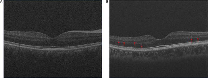 How early can we detect diabetic retinopathy? A narrative review of imaging tools for structural assessment of the retina.