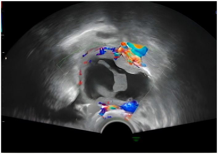 The Baffling Diagnosis of a Rare Case of Polypoid Endometriosis: Neoplasm Mimicking in a Young Pregnant Woman-A Case Report and Literature Review.