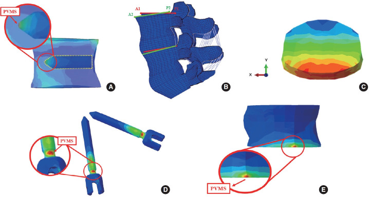 Biomechanical Impact of Cement Augmentation on Pedicle Screw Fixation and Adjacent Segment Disease in Multilevel Lumbar Fusion: A Finite Element Analysis.