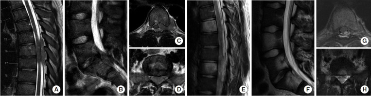 Advances in Metastatic Disease Spinal Oncology: Novel Technology Without Forgetting the Fundamentals of Surgical Treatment.