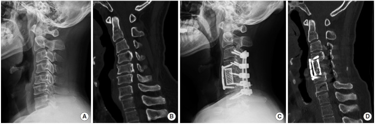 Surgical Strategy for Cervical OPLL with Kyphosis: Balancing Anterior, Posterior, and Combined Approaches - A Commentary on "Long-term Outcomes of Multilevel Anterior Cervical Osteotomy and Posterior Instrumentation for OPLL-Induced Myelopathy With Cervical Kyphosis".