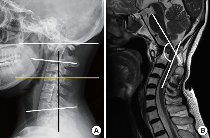 Prognostic Factors in Craniocervical Realignment for Crainovertebral Junction Kyphosis With Negative Cervical Imbalance: A Comprehensive Study.