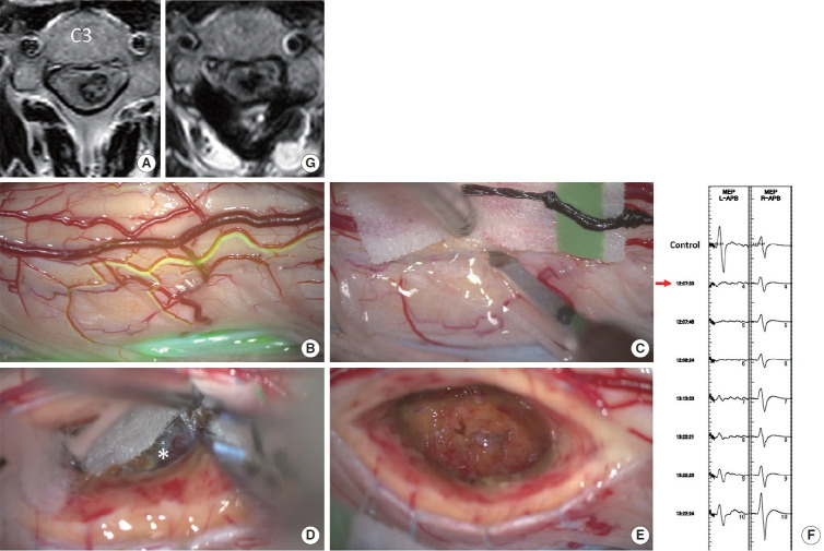 Posterolateral Sulcus Approach for Intramedullary Hemorrhage Associated With Cavernous Malformation of High Cervical Spine: Operative Technique and Outcomes.