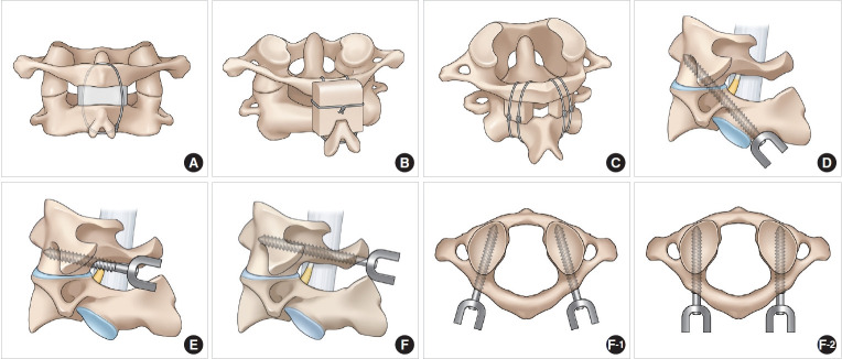 Atlantoaxial Reconstruction: The Artful Evolution of Craniovertebral Junctional Spine Surgery.