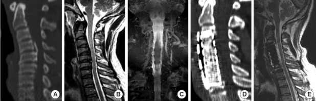 Long-term Outcomes of Multilevel Anterior Cervical Osteotomy and Posterior Instrumentation for OPLL-Induced Myelopathy With Cervical Kyphosis.