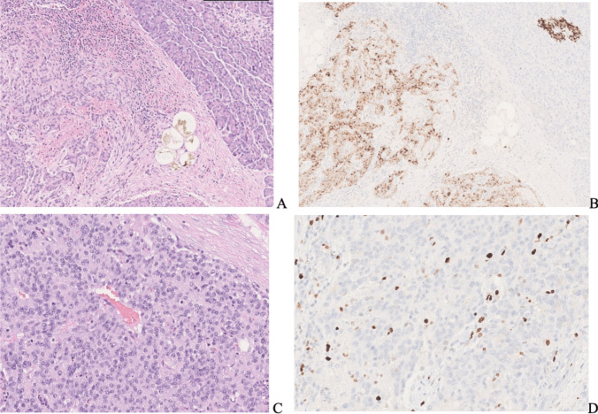 Association of type 1 stiff-person syndrome and insulinoma: a case report and narrative review.