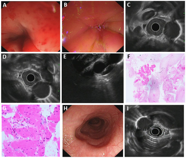 Diagnostic Value of EUS-FNA in the Differential Diagnosis of Esophageal Strictures Lacking Typical Malignant Features.