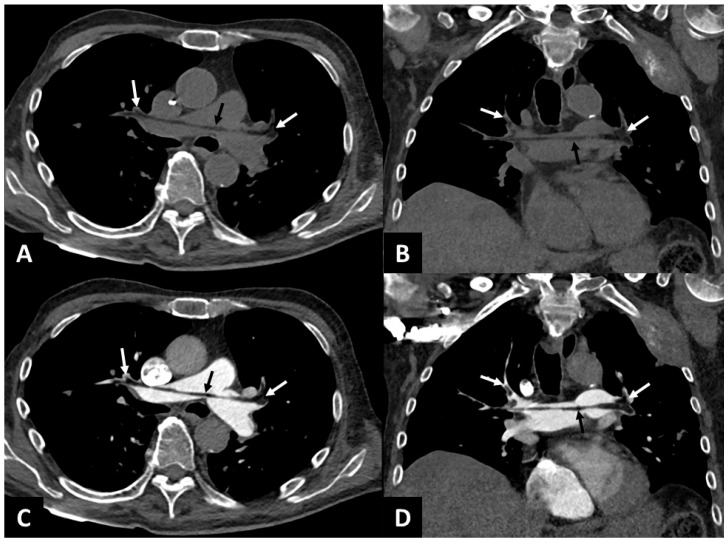 Proximal Pulmonary Fat Embolism on Non-Contrast Chest CT.