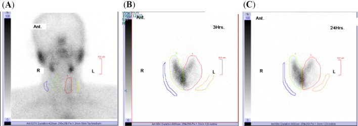 Thyrotoxicosis and Excess Iodine Due to Habitual Use of Polyvinylpyrrolidone Iodine While Gargling in an Iodine-sufficient Area.