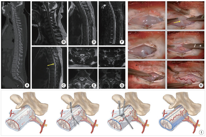 A Novel Clinical Insight Into Idiopathic Syringomyelia With Occult Arachnoid Webs: Neuropathological Features, Differential Diagnosis, and Surgical Strategy.