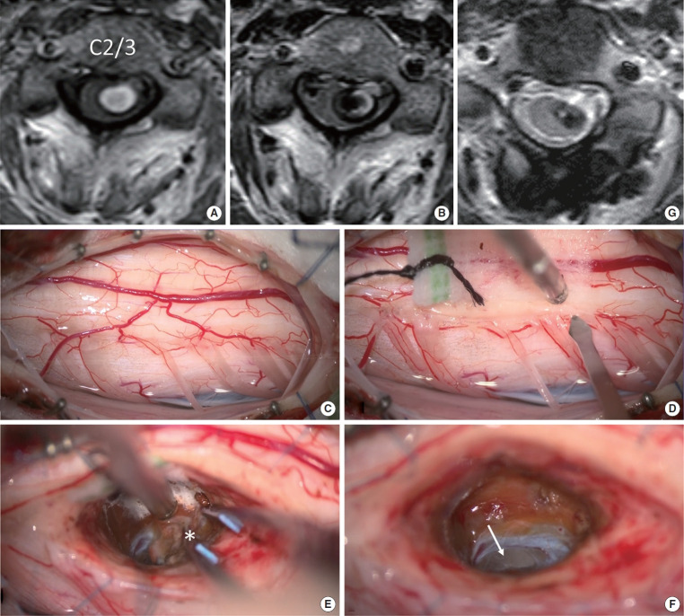 Posterolateral Sulcus Approach for Intramedullary Hemorrhage Associated With Cavernous Malformation of High Cervical Spine: Operative Technique and Outcomes.