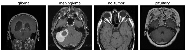 A Robust Semi-Supervised Brain Tumor MRI Classification Network for Data-Constrained Clinical Environments.