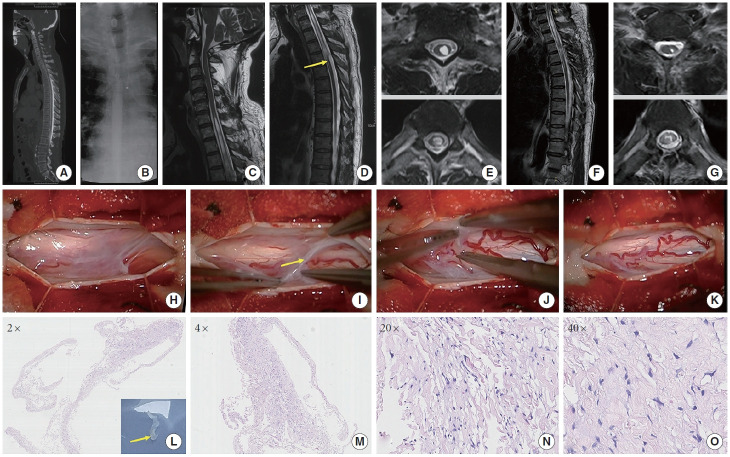 A Novel Clinical Insight Into Idiopathic Syringomyelia With Occult Arachnoid Webs: Neuropathological Features, Differential Diagnosis, and Surgical Strategy.