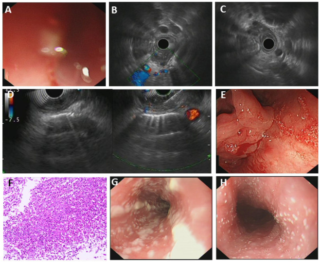 Diagnostic Value of EUS-FNA in the Differential Diagnosis of Esophageal Strictures Lacking Typical Malignant Features.