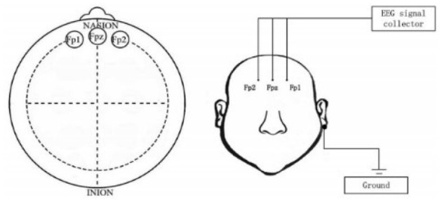A novel fast detection algorithm for depression based on 3-channel EEG signals.